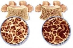 超声骨密度仪品牌：骨质变疏松的过程